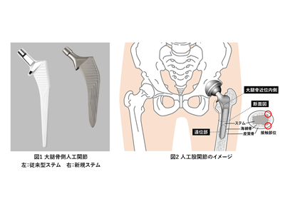 人工股関節、従来／新規ステム使用症例の骨密度や接触状態を比較－大阪公立大