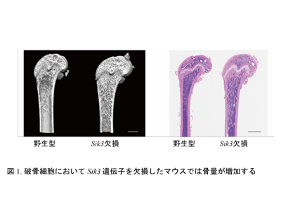 骨粗鬆症などの骨代謝性疾患、新規治療標的としてSIK3発見－富山大ほか