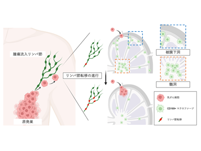 乳がん、新たな治療戦略としてCD169陽性マクロファージの重要性判明－京大ほか