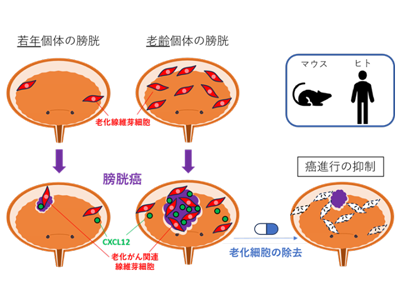 膀胱がん、老化がん関連線維芽細胞が進行を助長と判明－東大医科研ほか