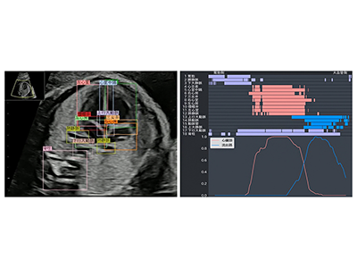 AI搭載の「胎児心臓超音波スクリーニング支援システム」開発、国内承認－理研ほか