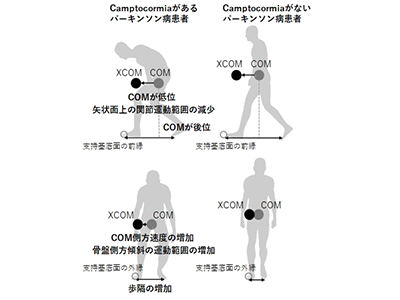 パーキンソン病、顕著な前屈姿勢あり患者の歩行不安定性と代償戦略を解明－畿央大