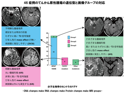 低悪性度てんかん原性腫瘍、遺伝子変異ごとのMRI画像パターン判明－NCNP