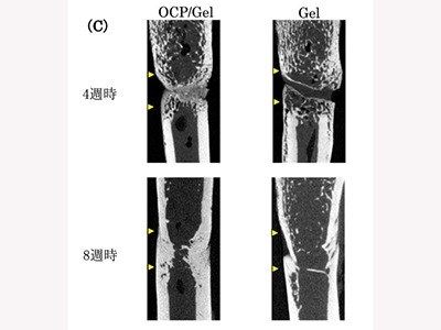 四肢骨等の骨欠損修復用の新規人工骨OCP/Gelを開発・発売－東北大ほか