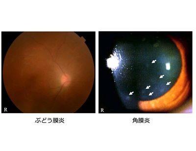 若年層のHTLV-1性感染症例、短い潜伏期間で眼疾患発症－科学大ほか