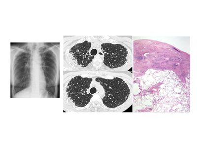 特発性上葉優位型肺線維症、臨床的特徴などのレビュー論文を発表－浜松医科大