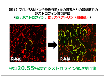 DMDのエクソン44スキップ薬、医師主導治験でジストロフィン発現を確認－NCNPほか