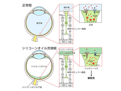 眼内充填剤「シリコーンオイル」による視力低下の原因の一端を解明－名大ほか