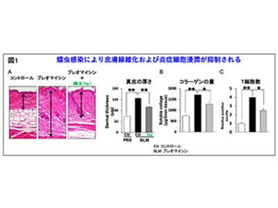 全身性強皮症における線維化の進行、Treg細胞活性化で抑制の可能性－群大ほか